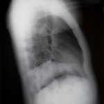 An x-ray of a lung.